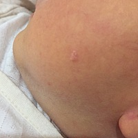 宝宝一出生脸上就长了类似小水泡型的疙瘩，医生说说宝宝还太小，等过段时间再去医院看看，有宝妈妈们见...