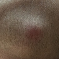 请问各位妈妈，有没有遇见过这种情况。我家宝贝，这两天脑后面有个小疙瘩，请妈妈们帮我看看，我的心十...