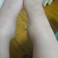 脚踝肿了，怀孕36周了，你们肿了怎么样，正常不