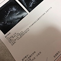 有没有这样囊肿的，右侧小腹偶尔隐痛，搞得我现在都睡不好，就怕会严重