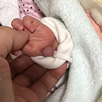 不知道什么原因，宝宝大拇指旁边长了这么一块肉，上面还有指甲，医生说就是多长了一个手指，这个以后做...