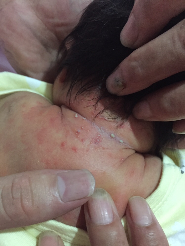 这个是不是湿疹啊？宝宝睡觉的时候这些地方根本无法透气啊