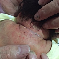 急死人了宝宝才五天，不知道怎么办，发现的晚，有没有人也有这种情况啊 这个是不是湿疹啊？宝宝睡觉的时...