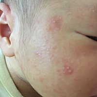 宝宝脸上长这些是什么东西呀？用什么可以擦掉呢？