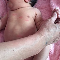 求救，有没有当医生的宝妈，帮忙看看。我家宝宝出生十天，身上长这种红疙瘩，每次哭闹或者是热就更多，...