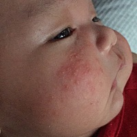 这是湿疹吗 要抹点什么