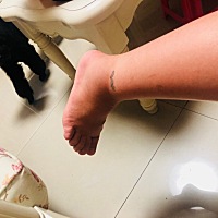 又跟我一样肿的厉害的宝妈吗？都青了，吓死我了