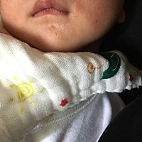 宝宝这是胎毒还是什么