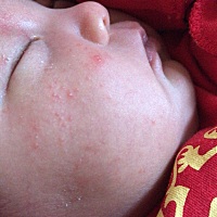 各位宝妈，有没有宝宝得湿疹的，我家宝宝二十天了脸上起了湿疹，刚开始不算多，看网上有一种杏璞霜，不...