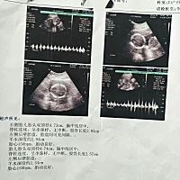 姐妹们！帮忙看一下，B超是20周 1做的，羊水和股骨都超出最低值怎么办？之前无创和NT都很正常！不会畸形...