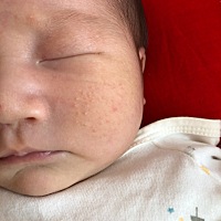 宝妈们 宝宝脸上起的这是啥 需要摸什么东西