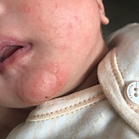 宝贝这是湿疹吗？你们用什么怎么处理？？谢谢