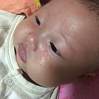 脸上一颗颗的到底是什么啊！医院说是湿疹，可是湿疹药膏擦了也没用，烦死了。