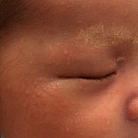 我女儿才出生半个月，也不知道这个长的是什么，问医生，有的说是湿疹有的说是痱子，我表妹说擦婴宝，昨...