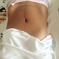 宝宝都两个月了，这条线多久才能消失呀！