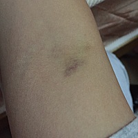 之前发表过，个个都说是我的问题，不是护士的问题，这次是同一个护士，血管没找到就跟我抽血，抽成这样...