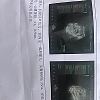 刚做的NT谢谢大家、医生都没跟我说，还是在这看到大家都做啦我才去的