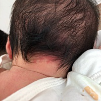 宝妈们 有谁知道宝宝脖子上面那个红印是啥