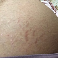 有没有像我一样的宝妈，35周才开始长妊娠纹的 😭😭还窃喜以为自己不会长得！好难过啊