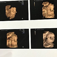 宝宝十天了。剖腹产疼痛已经慢慢好转。