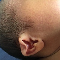 我家宝宝刚出生耳朵在子宫里受到挤压了，大家都说能长上去，还是有点担心，有遇到过同样情况的宝妈吗？