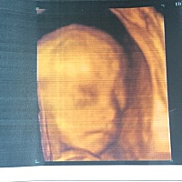 报喜～孕四十周剖宫产女宝，7.2斤。发现比较及时，40周孕检时羊水太少，晚期一定要注意胎动羊水及胎心。...