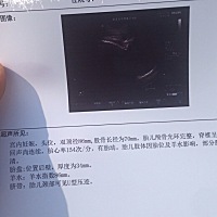 按月经期算37周、可是今天照了B超还是偏小2周，医生建议打氨基酸2天（请问有没有孕妈有个这样的情况，氨...