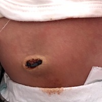 请问一下 18天宝宝肚脐还在流褐色的血正常吗？