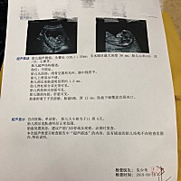 今天做的NT，医生说胎盘低置不知道是什么意思，有什么要注意的吗？