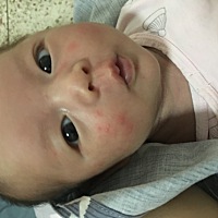 宝宝今天脸上长了好多这个，有谁知道是怎么回事啊？该怎么办呢？