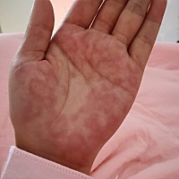 月子13天手上起的红疙瘩 不挠不痒 越挠越痒 有没有一样的？