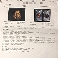 B超检查说胎儿胆囊偏小，怎么办啊