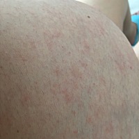 求助一下，现在孕37周+，最近肚子上长了很多这样的红斑，最开始只有一点，后来长了一片，很痒，去医院查...