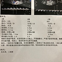 这是27周的时候做的B超。现在29+7天了。孕前体重50kg，现在是63kg……不知道三个宝宝现在有多大了....本...