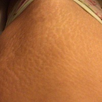 有没有宝妈听过或者在用“豹纹妈妈”这个去除妊娠纹的产品啊？最近偶然看到的，广告效果很惹人注目，价...