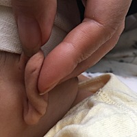 宝宝耳朵前面小洞是瘘管，后面这个是什么。