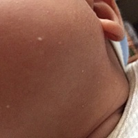 宝宝两个月，脸上长这种小白点点，是什么啊？是不是正常的呢？有宝妈知道吗？