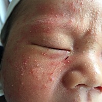 宝宝才1个月大，脸上长满了的湿疹不知道擦什么药效果好点