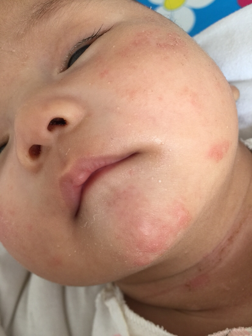 宝宝俩月了 一直是母乳 也配奶粉吃 主要是母乳 我也不怎么吃辣的 有人知道 宝宝脸上咋回事吗 而且脸上还干