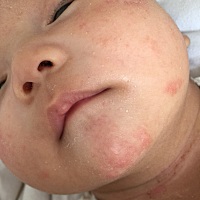 宝宝俩月了 一直是母乳 也配奶粉吃 主要是母乳 我也不怎么吃辣的 有人知道 宝宝脸上咋回事吗 而且脸上还...