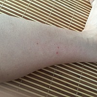 有没有宝妈孕晚期左右小腿痒的难受，有知道是怎么回事的吗，痒了十来天了，这是自己抓的