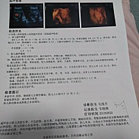 三维顺利通过啦！宝宝估计困了。啊着嘴巴睡觉还拿手挡着。医生又叫我出去走一个小时回来继续照！后面几...