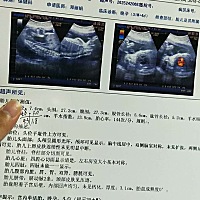 胎动拳脚踢打得    有时候肚子还鼓了个包  有时候胎动左右都动   请问是男孩女孩   哪个看得懂B超单子帮...