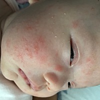 宝宝脸上长的不知道是什么，感觉好难受