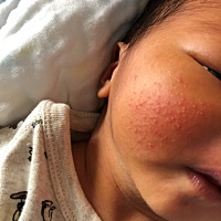 请问一下小宝宝脸上有这个小痘痘怎么办？