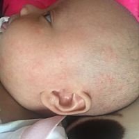 宝宝爱长湿疹，脸蛋、头以及身上都是，各位宝妈又有什么好方法应对，谢谢，请告知