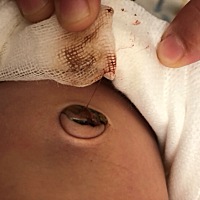 宝宝刚生下7天，今天早上发现脐带出血，中午出现抽搐现象，爸妈给送到医院住院了，照了脑补CT没什么问题...