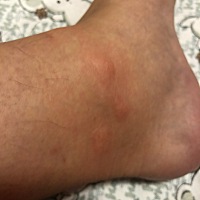 身上突然长了好多像蚊虫叮咬的疙瘩 很痒很红 有没有知道咋回事的 每一个包上面都有个眼