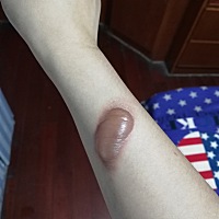 被烫了，咋办，两天了都这样，感觉不破不会好，破了又怕感染，又不想涂药，怎么办