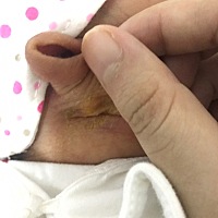 宝宝耳朵后面这个黄色的痂是怎么回事。